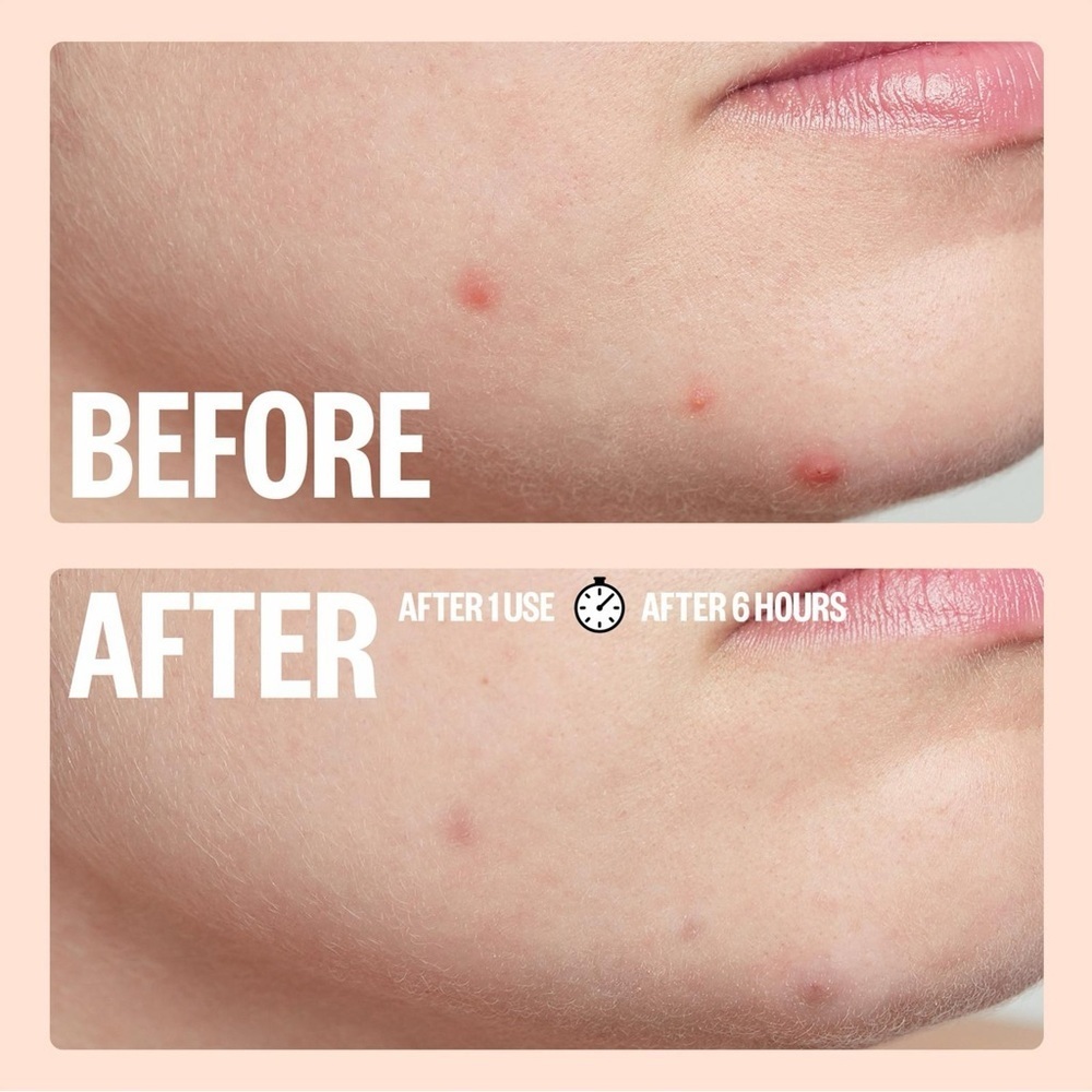 Peace Out Salicylic Acid Acne Healing Dots | NEW | 20 Count | BNIB - Picture 6 of 12